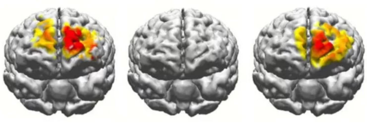 Электрическая стимуляция мозга